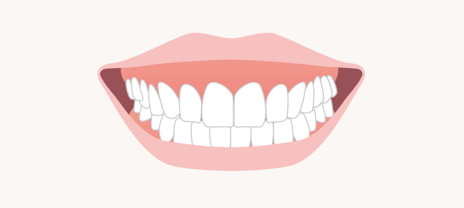 唇の位置が上がりすぎているイメージ