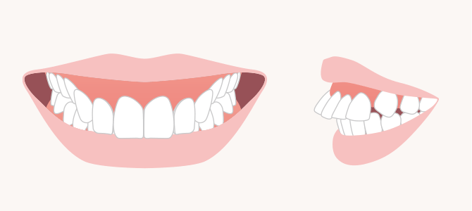 歯の位置が下すぎ＋前過ぎのイメージ