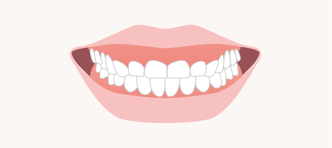 歯の長さが小さい＋短いイメージ