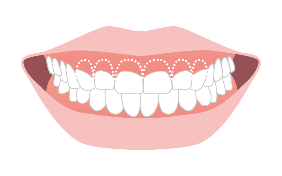 歯冠長延長術のイメージ