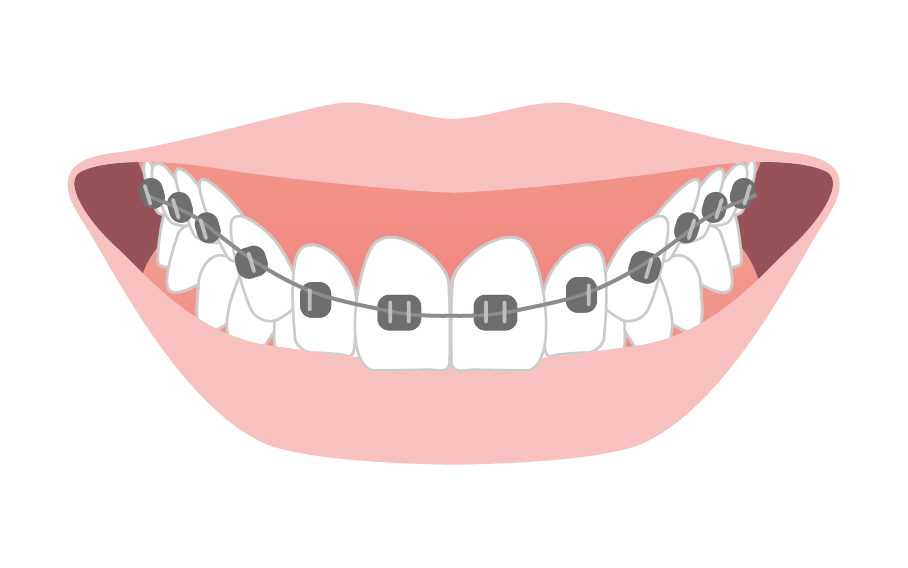 歯列矯正のイメージ