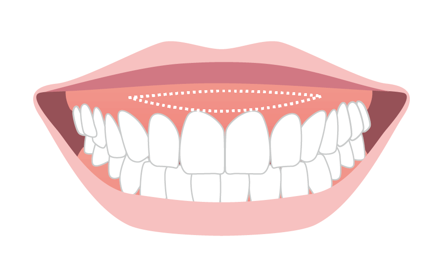 上唇粘膜切除術のイメージ