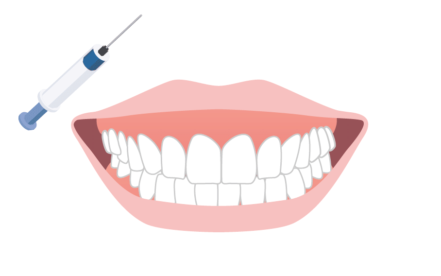ボトックス注射のイメージ