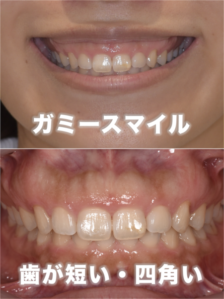 GUMMY SMILE CLINIC の症例画像