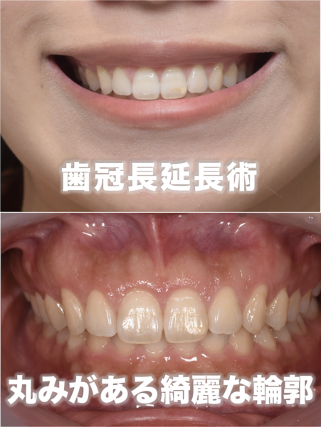 GUMMY SMILE CLINIC の症例画像2